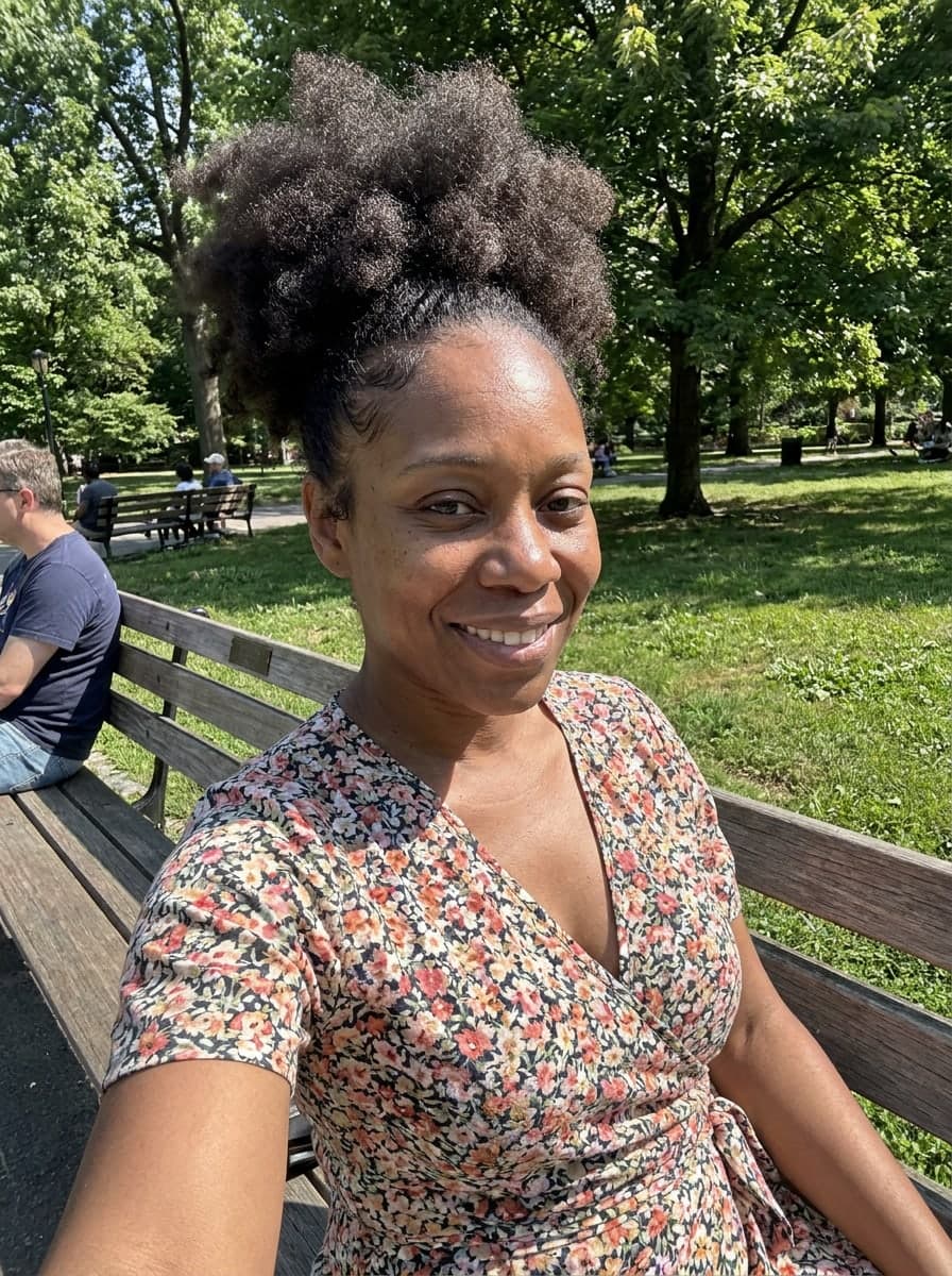 Traction alopecia filled in — After