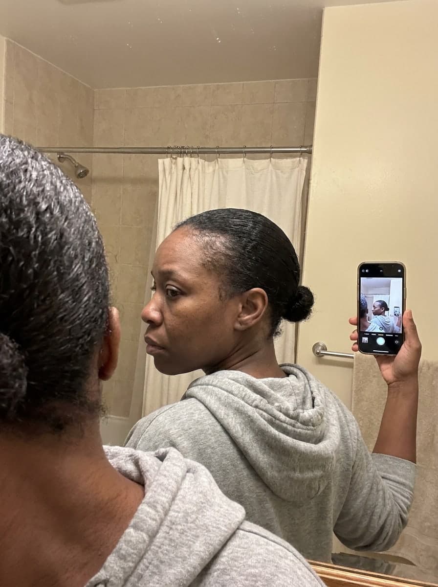 Traction alopecia filled in — Before
